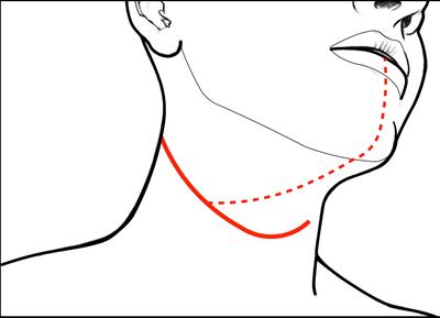 Step-by-Step Cadaver Dissection and Surgical Technique for Compartmental Tongue and Floor of Mouth Resection